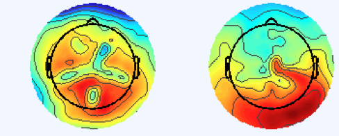 TWO TOPOGRAPHIC SCALP MAPS SHOWING EEG ACTIVITY DISTRIBUTED OVER THE SCALP.  POSITIVE ACTIVITY IS DEPICTED IN WARMER COLORS AND NEGATIVE ACTIVITY IN COOLER COLORS.