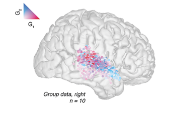 Brain image from Auditory Cortex meeting poster showing regions sensitive to onsets and sustained portions of speech sounds