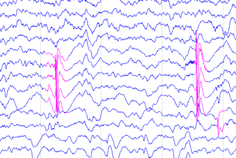 Intracranial EEG waveforms showing detected seizure activity from methods described in Baud et al. in the journal Neurosurgery
